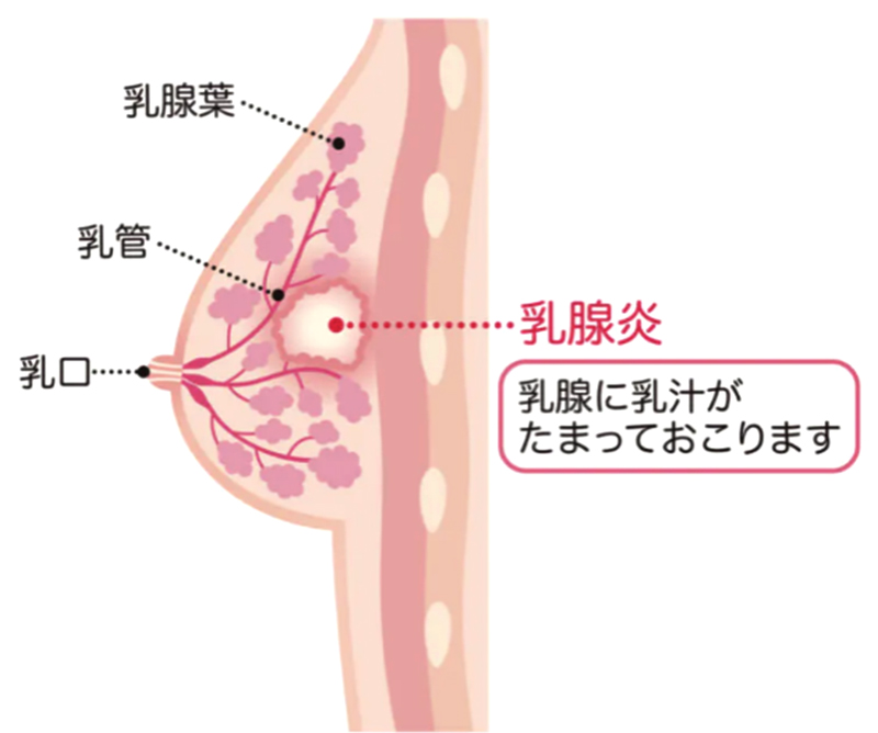 乳腺炎とは